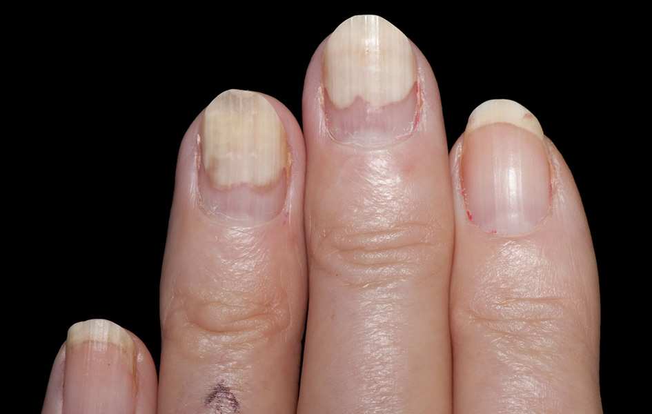 Что означают белые пятна на ногтях рук. Псориатический онихолизис. Точечная лейконихия на ногтях.